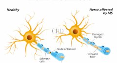 CBD and Multiple Sclerosis