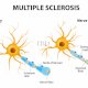 CBD and Multiple Sclerosis