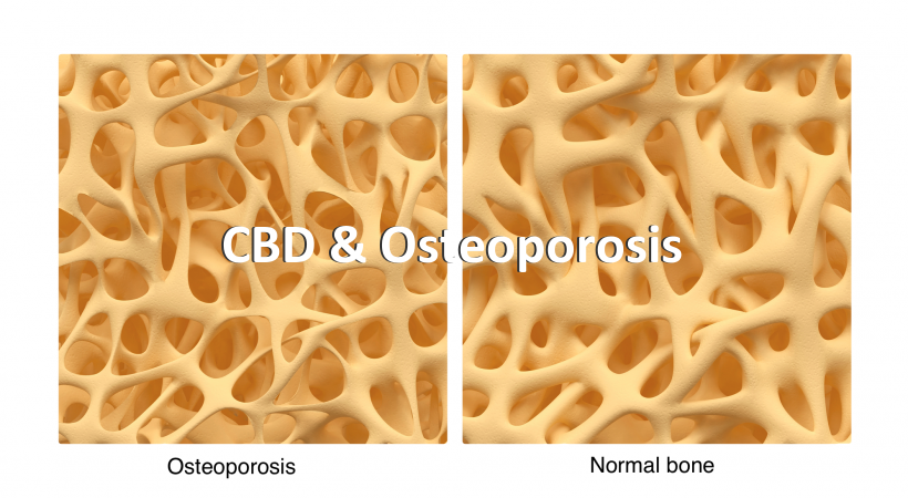 CBD & Osteoporosis