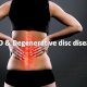 CBD and Degenerative disc disease