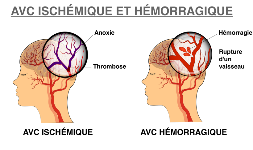 AVC Ischémique et hémorragique 