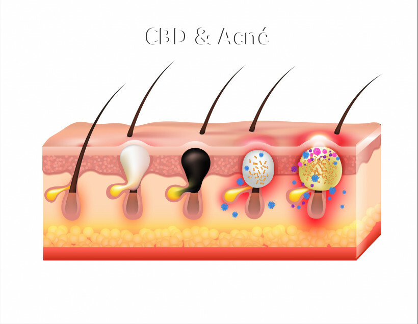 CBD & Acné