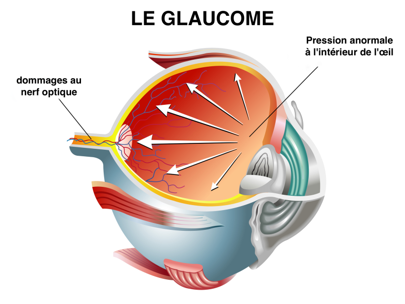 Glaucome