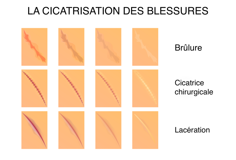 Cicatrices et blessures